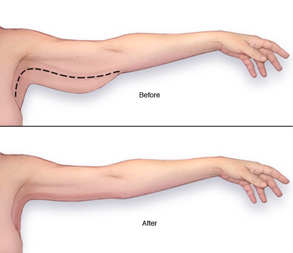 Description: Arm-Reduction